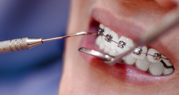 Braces (Alignment) Services provided at BENGALI Physicial & Dental Clinic