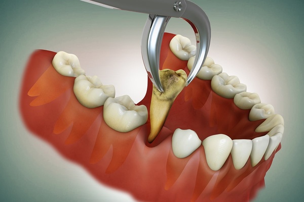 Teeth Replacement Services provided at BENGALI Physicial & Dental Clinic