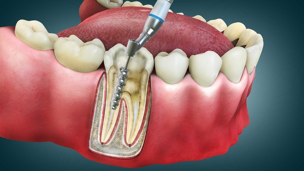 Root Canal & Fillings Services provided at BENGALI Physicial & Dental Clinic