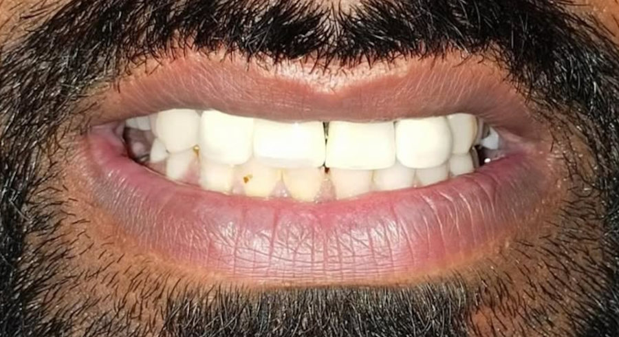 After Dentist Treatment