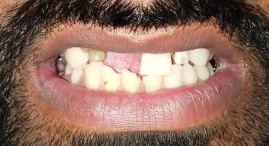 Before Dentist Treatment