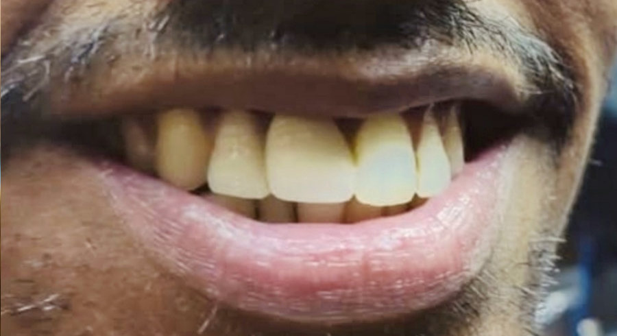 After Dentist Treatment