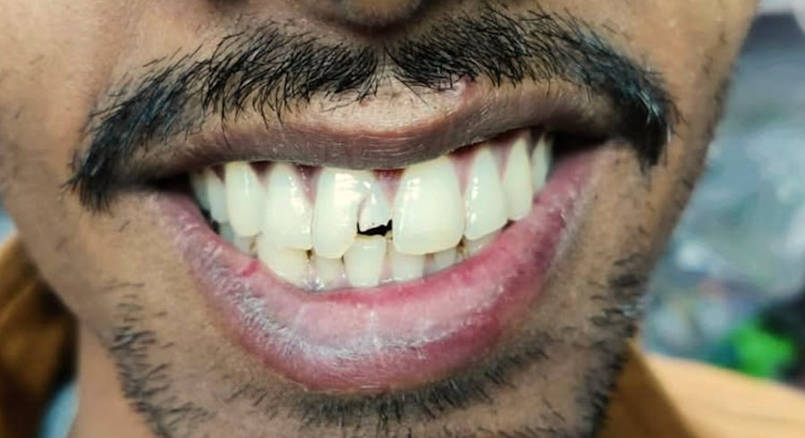 Before Dentist Treatment